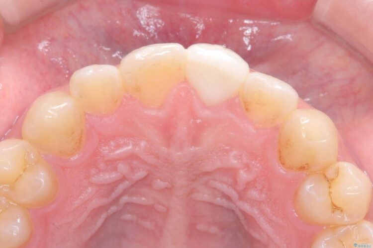 他院で治療困難と言われた|欠けた歯の神経を残しセラミック修復 治療後画像