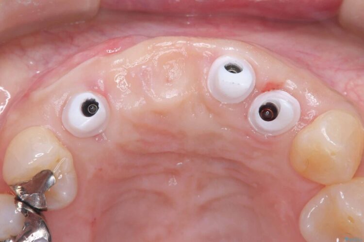 1DAYインプラント|前歯5本の治療を痛みもなく3ヶ月で完了 治療後画像