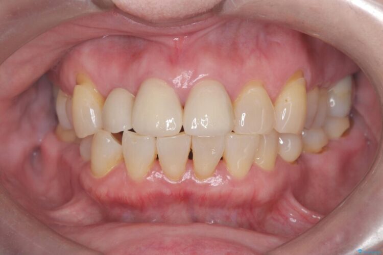 矯正治療はしたくない!抜歯即時インプラント+オールセラミッククラウンで審美修復 治療後画像