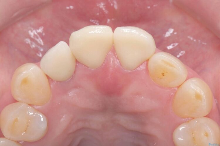 矯正治療はしたくない!抜歯即時インプラント+オールセラミッククラウンで審美修復 治療後画像