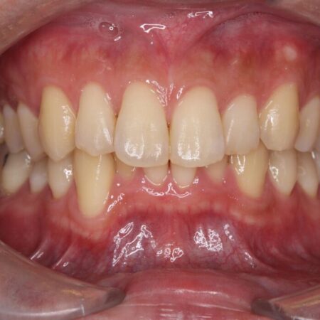 はじめてのオフィスホワイトニング 治療前