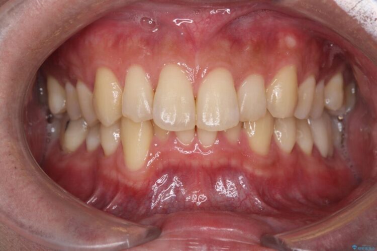 はじめてのオフィスホワイトニング 治療前画像