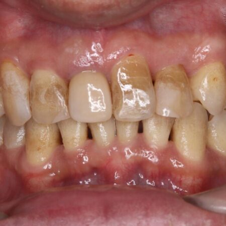 エアフロークリーニングですっきり清潔 治療前