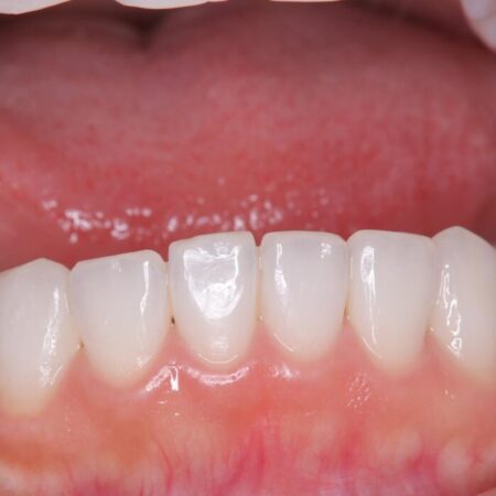 結婚式に向けてオフィスホワイトニング 治療前