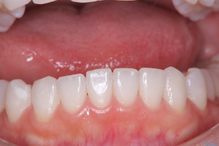 結婚式に向けてオフィスホワイトニング ビフォー