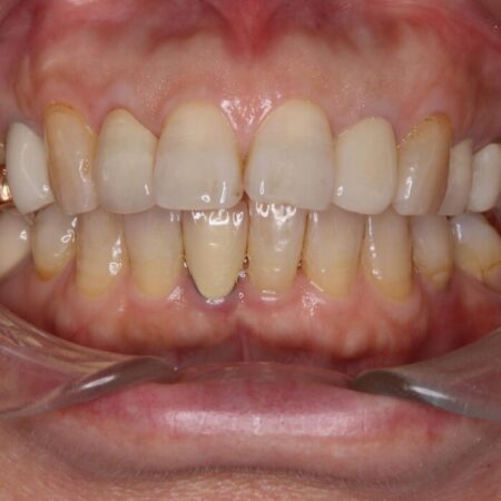 セラミッククラウン作成に向けホワイトニング 治療前