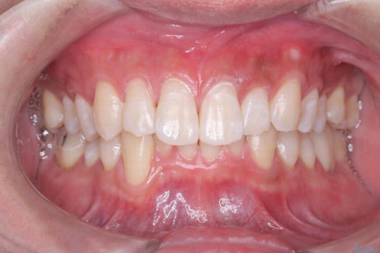 はじめてのオフィスホワイトニング 治療後画像