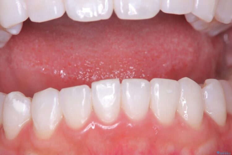 結婚式に向けてオフィスホワイトニング 治療途中画像