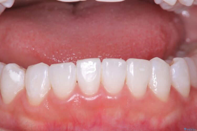 結婚式に向けてオフィスホワイトニング アフター