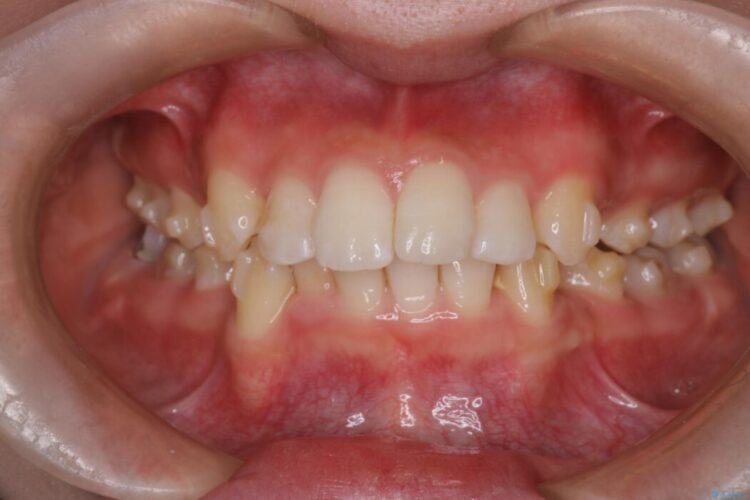 重度の歯のがたつきをインビザラインで改善 治療途中画像