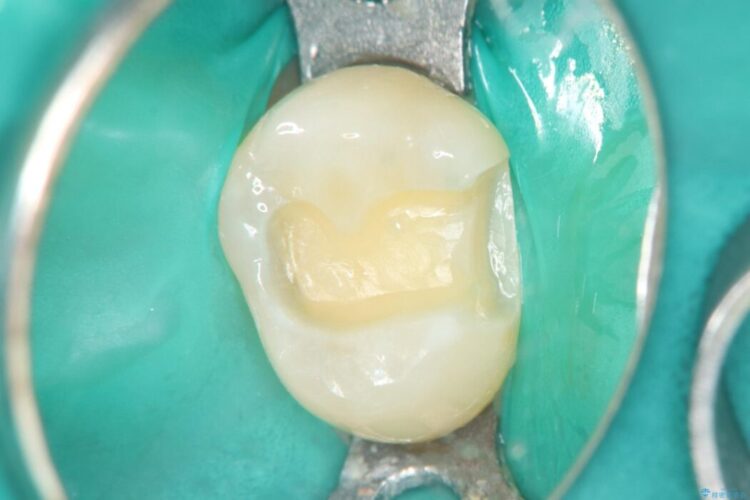 2回の来院で完了！奥歯のセラミック修復 治療途中画像