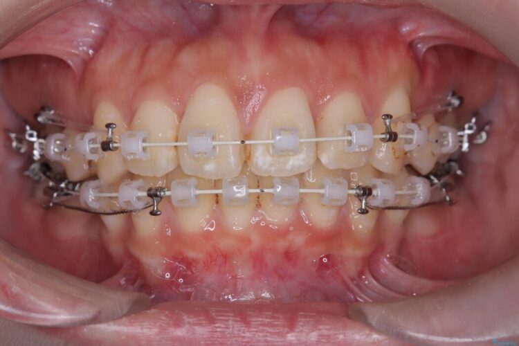 ワイヤー矯正で口元の突出感を改善!横顔を美しく 治療途中画像