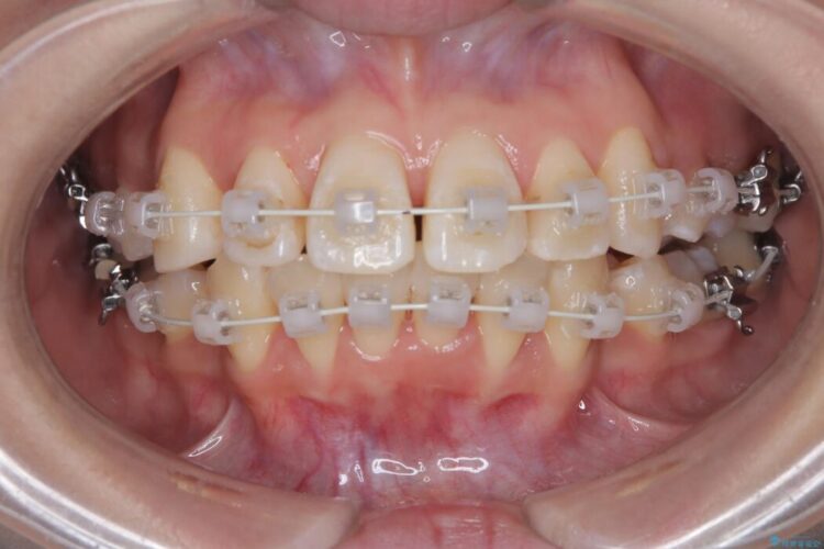 目立ちにくいワイヤー矯正で八重歯と正中のズレを解消 治療途中画像
