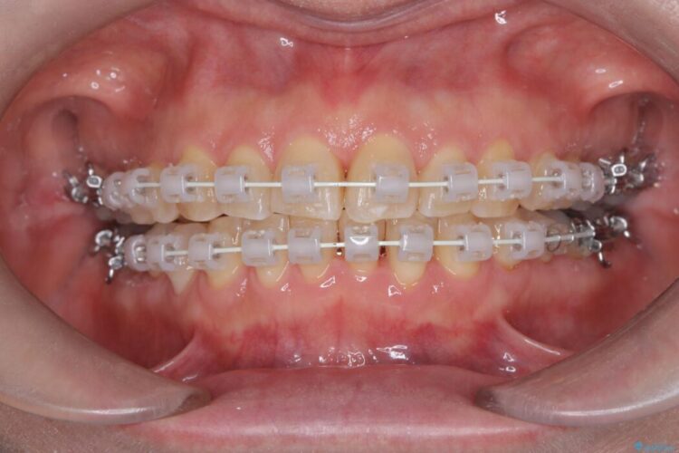 1年で完了！前歯の軽度なガタつきをワイヤー矯正で美しく 治療途中画像