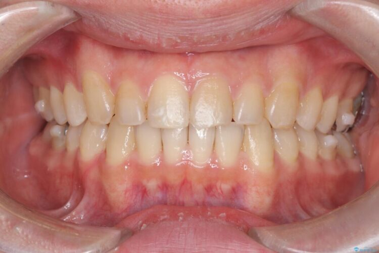 正中離開・クロスバイト・すきっ歯・叢生|インビザラインで改善 治療途中画像