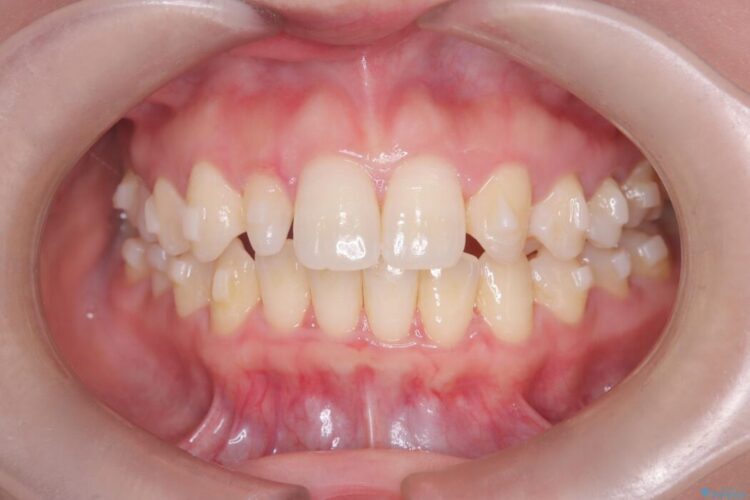 軽度の叢生|わずか5か月の短期間矯正 治療途中画像