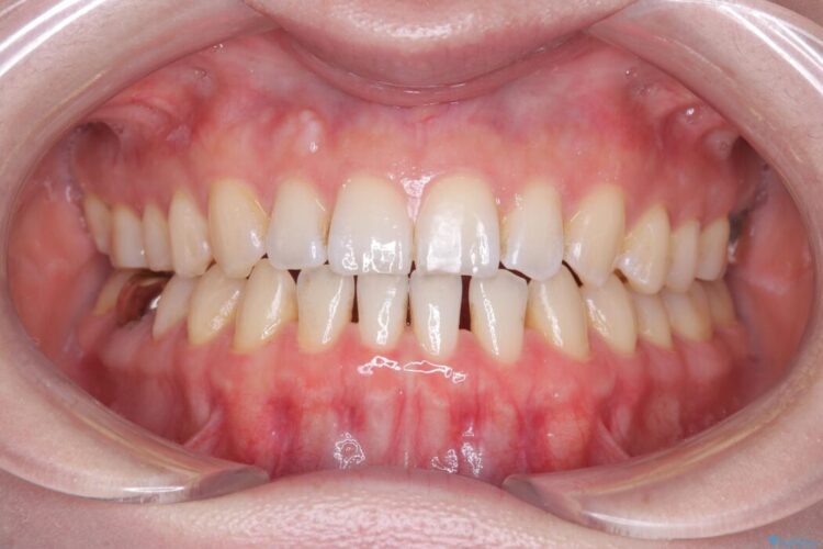 すきっ歯・切端咬合・空隙歯列をインビザラインで短期間矯正 治療途中画像