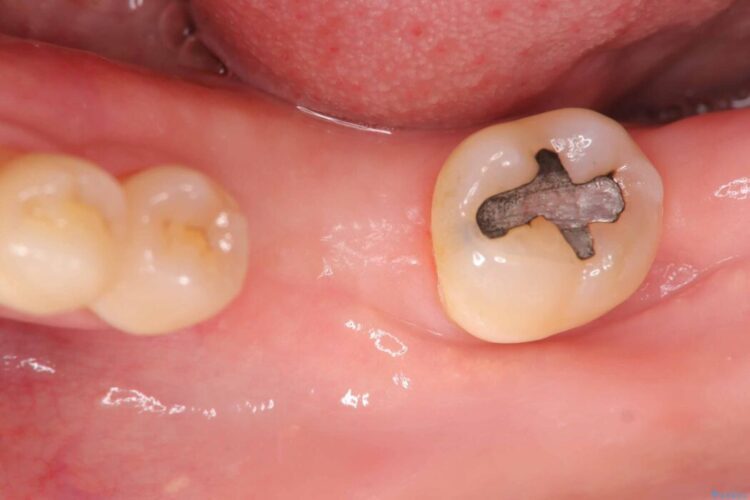根尖性歯周炎|分岐部病変|パーフォレーション|インプラント治療で改善 治療途中画像