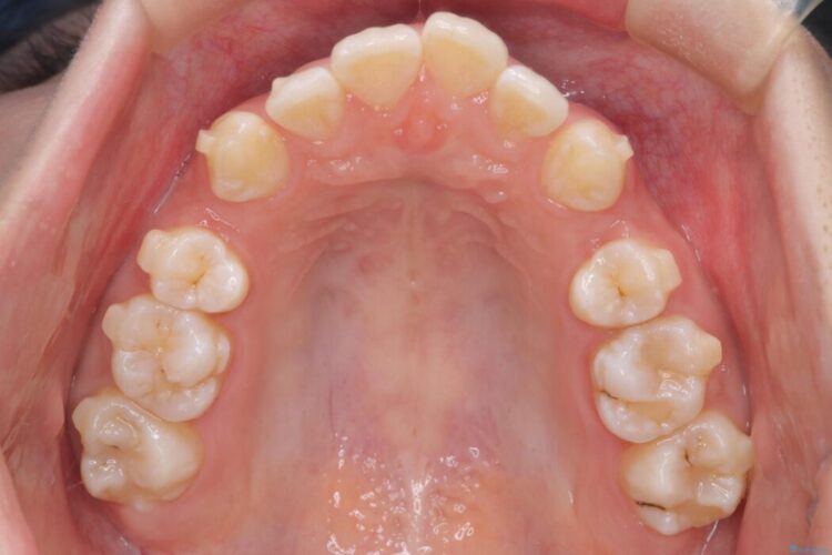 重度の歯のがたつきをインビザラインで改善 治療途中画像