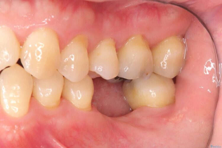 根尖性歯周炎|分岐部病変|パーフォレーション|インプラント治療で改善 治療途中画像