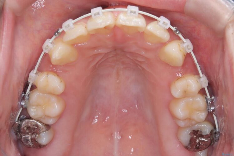 ワイヤー矯正で口元の突出感を改善!横顔を美しく 治療途中画像