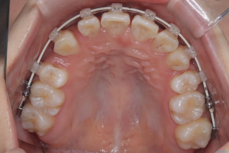 ワイヤー矯正で八重歯と正中のズレを解消 治療途中画像