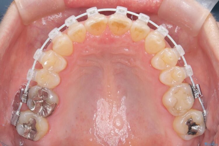 1年で完了！前歯の軽度なガタつきをワイヤー矯正で美しく 治療途中画像