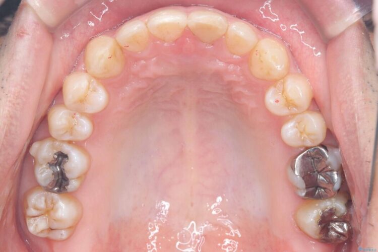 正中離開・クロスバイト・すきっ歯・叢生|インビザラインで改善 治療途中画像