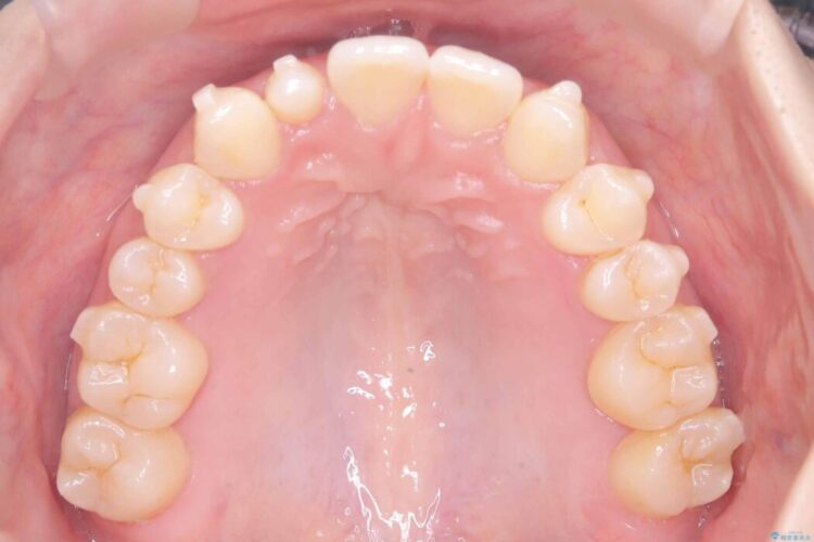 軽度の叢生|わずか5か月の短期間矯正 治療途中画像