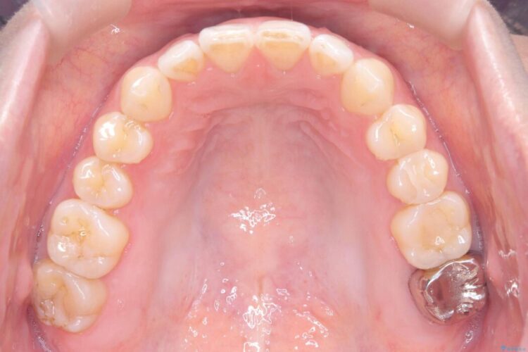 すきっ歯・切端咬合・空隙歯列をインビザラインで短期間矯正 治療途中画像