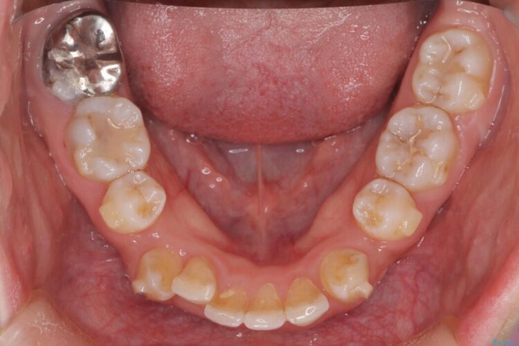 重度の歯のがたつきをインビザラインで改善 治療途中画像
