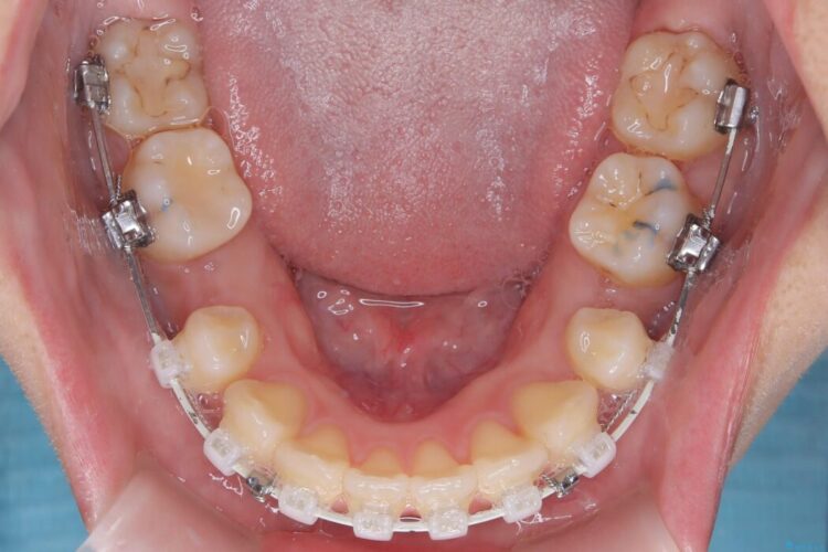 ワイヤー矯正で口元の突出感を改善!横顔を美しく 治療途中画像