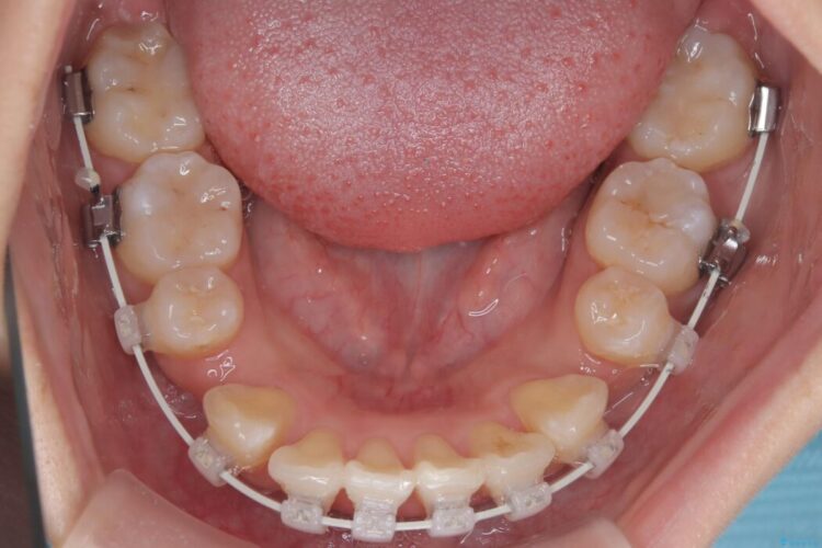 目立ちにくいワイヤー矯正で八重歯と正中のズレを解消 治療途中画像