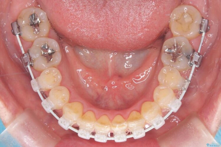 1年で完了！前歯の軽度なガタつきをワイヤー矯正で美しく 治療途中画像