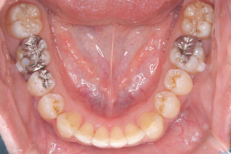 正中離開・クロスバイト・すきっ歯・叢生|インビザラインで改善 治療途中画像