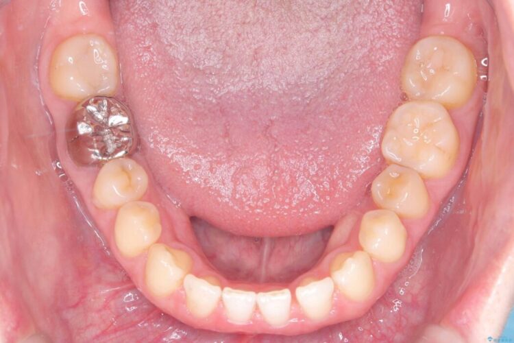 すきっ歯・切端咬合・空隙歯列をインビザラインで短期間矯正 治療途中画像