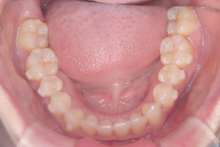 軽度の叢生|わずか5か月の短期間矯正 治療途中画像