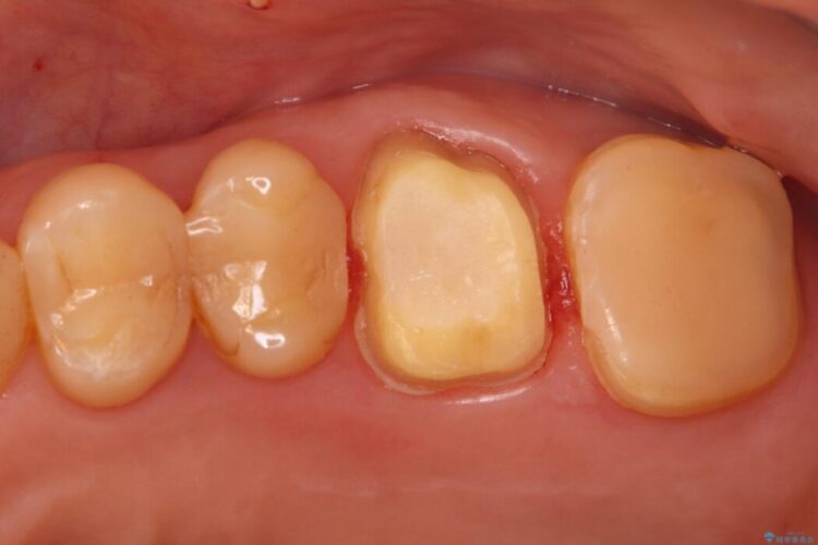 奥歯の痛みを解消!クラウンで長期的に歯を守る 治療途中画像