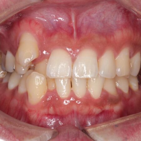 目立つ八重歯と下の歯の凸凹を治したい 治療前