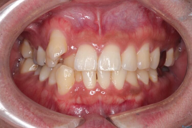 目立つ八重歯と下の歯の凸凹を治したい ビフォー