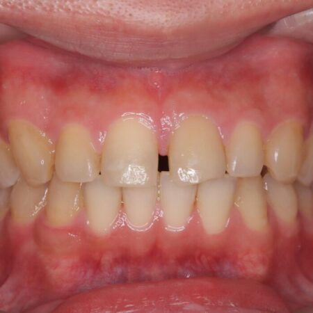 正中離開・クロスバイト・すきっ歯・叢生|インビザラインで改善 治療前