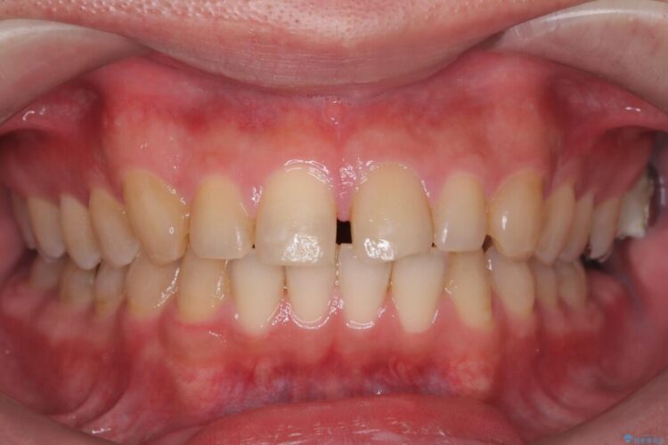 正中離開・クロスバイト・すきっ歯・叢生|インビザラインで改善 治療前画像