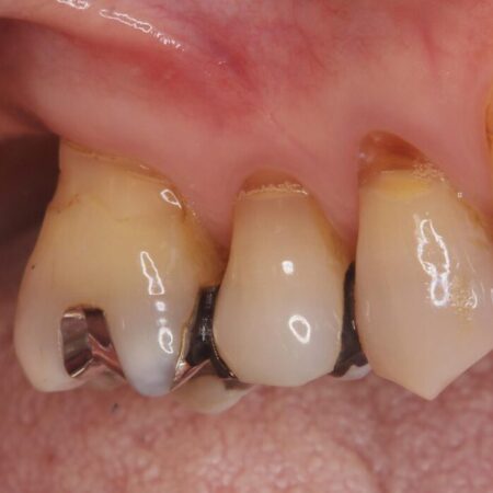 重度歯周病で失った2本の奥歯を1DAYインプラント治療 治療前