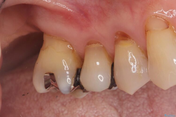 重度歯周病で失った2本の奥歯を1DAYインプラント治療 治療前画像