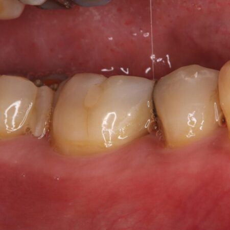 欠けた奥歯をPGAで補強。違和感のない咬み心地へ 治療前