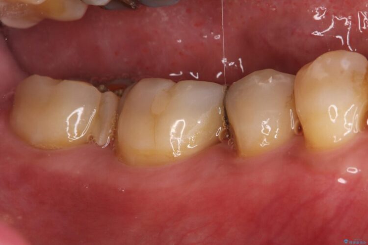 欠けた奥歯をPGAで補強。違和感のない咬み心地へ 治療前画像