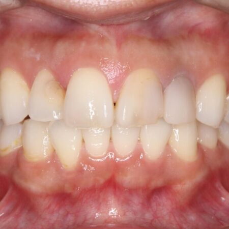 欠けて変色した前歯をオールセラミックで美しく 治療前