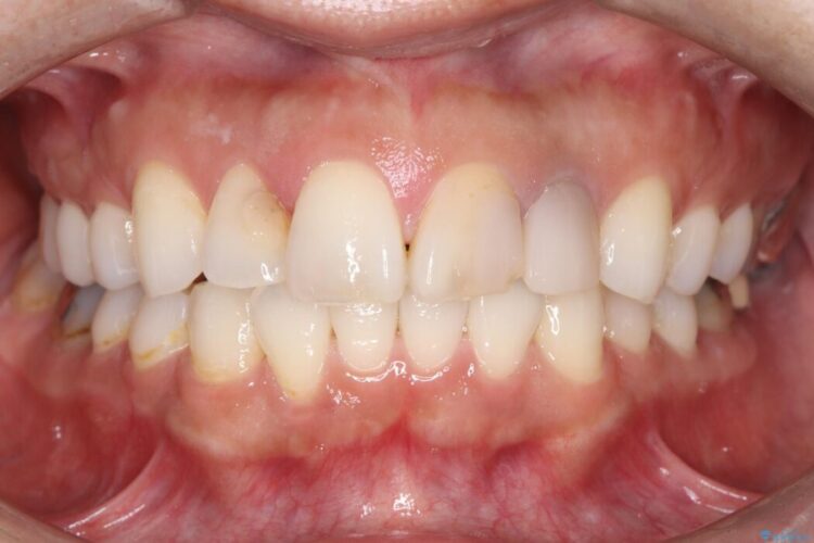 欠けて変色した前歯をオールセラミックで美しく 治療前画像