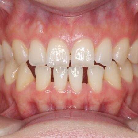 すきっ歯・切端咬合・空隙歯列をインビザラインで短期間矯正 治療前