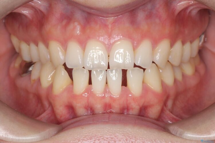 すきっ歯・切端咬合・空隙歯列をインビザラインで短期間矯正 ビフォー